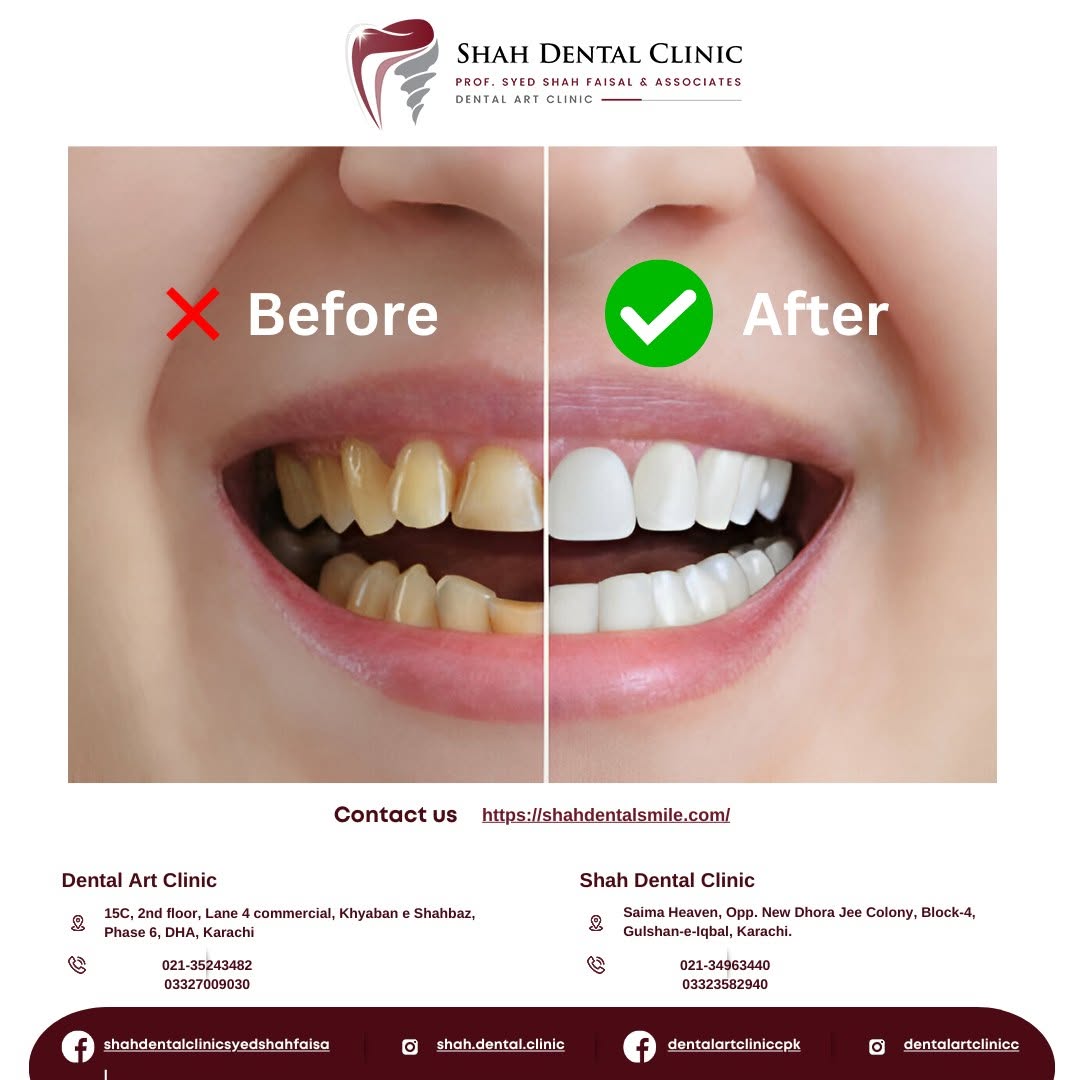 Befor and After teenth cleaning
