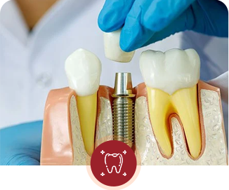 DENTAL IMPLANT